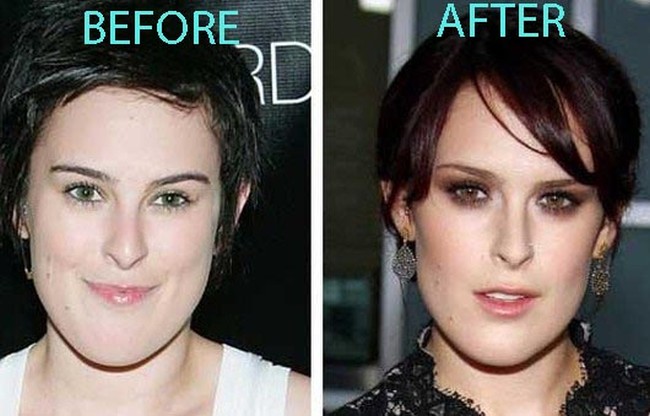 Rumer-Willis-before-and-after-chin-surgery.jpg