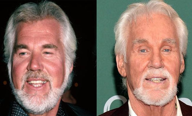 kenny rogers before and after