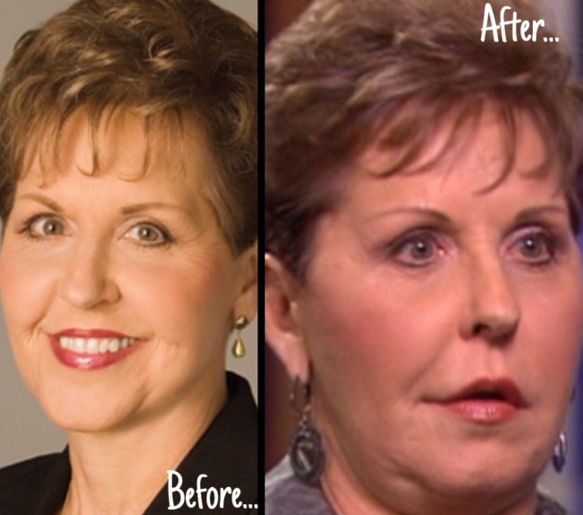 Joyce Meyer before and after nose job and lip implants