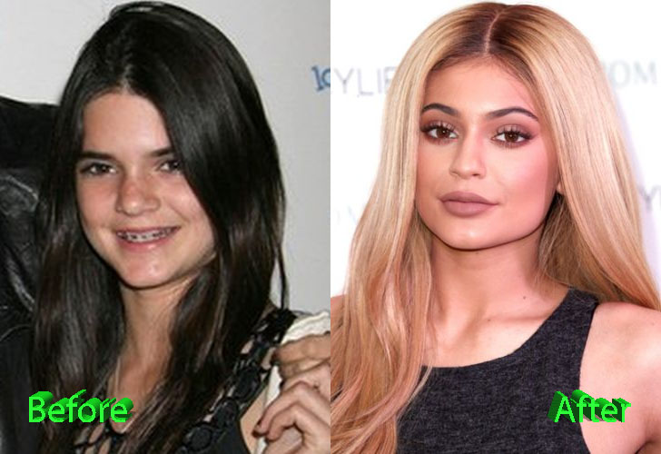 Kylie Jenner Plastic Surgery Before and After