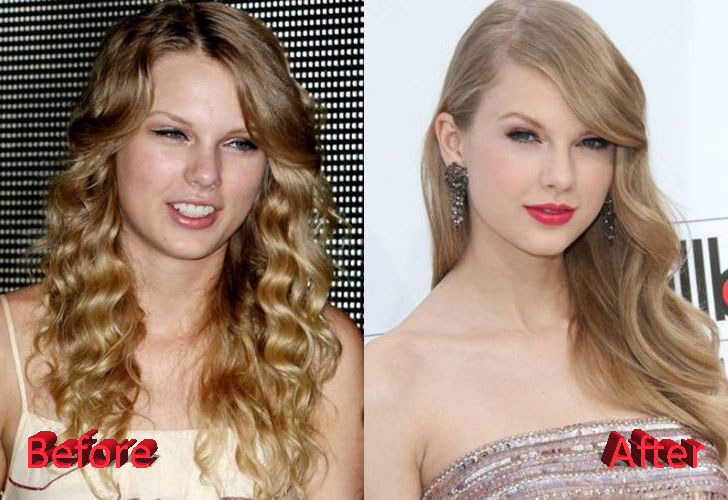 Taylor Swift Plastic Surgery Before and After