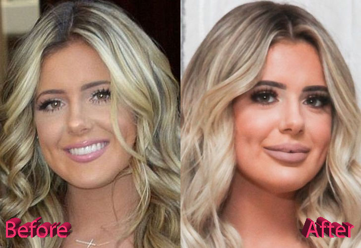 Brielle Biermann Before and After Cosmetic Surgery