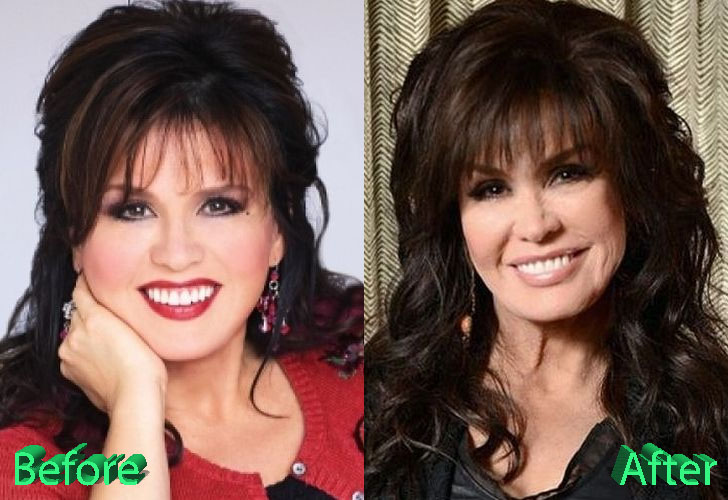 Marie Osmond Plastic Surgery Marie's Youthful Looks