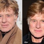 Robert Redford before and after plastic surgery