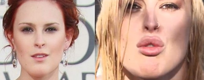 Rumer Willis before and after photos lip augmentation
