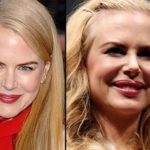 Nicole Kidman before and after plastic surgery facelift, botox, lip implants