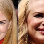 Nicole Kidman Plastic Surgery