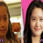 Yoona plastic surgery Before and After