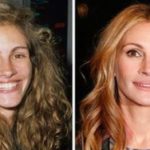 Julia Roberts before and after pictures