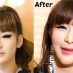 Park Bom plastic surgery disaster