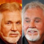 Kenny Rogers before and after plastic surgery