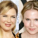 Renee Zellweger Plastic Surgery Before and After