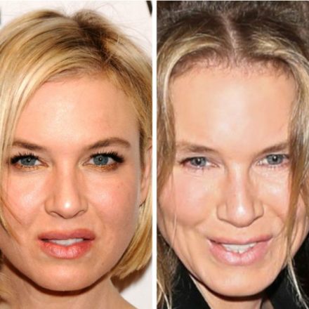 What Experts And Others Have to Say About Renee Zellweger Plastic Surgery?