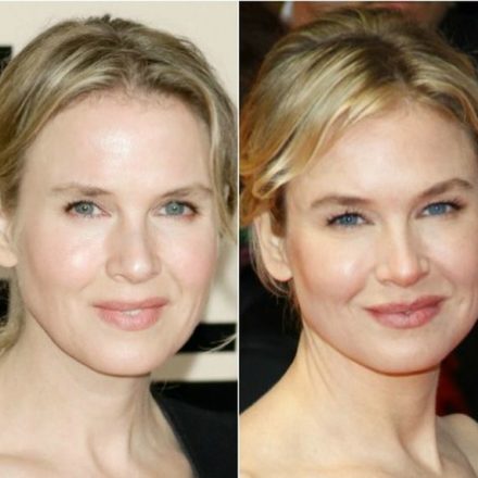 What Experts And Others Have to Say About Renee Zellweger Plastic Surgery?