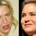 Renee Zellweger Before And After Plastic Surgery