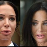 Tulisa Paulinea Contostavlos lip implants