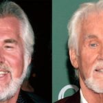 What happened to Kenny Roger before after 150x150