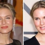 Renee Zellweger surgery before and after