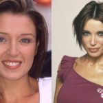 Danii Minogue Before And After Lip Augmentation