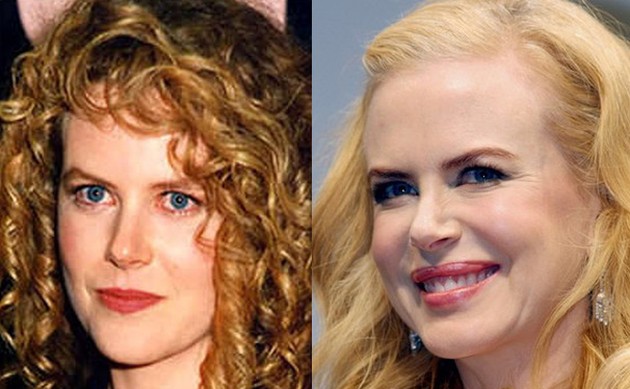 Celebrity Nicole Kidman plastic surgery mistake