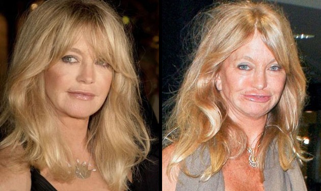 Goldie Hawn plastic surgery gone bad