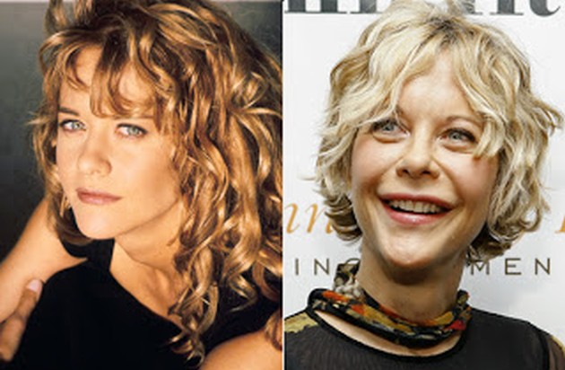 Hollywood Celebrity Meg Ryan before and after surgery photos
