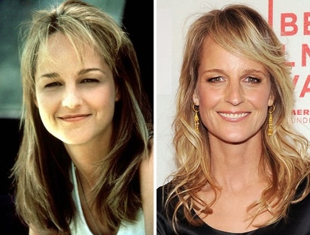 Helen Hunt Before And After Botox Treatments