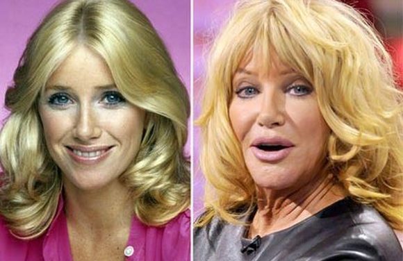 Reviews and Facts of Suzanne Somers Plastic Surgery