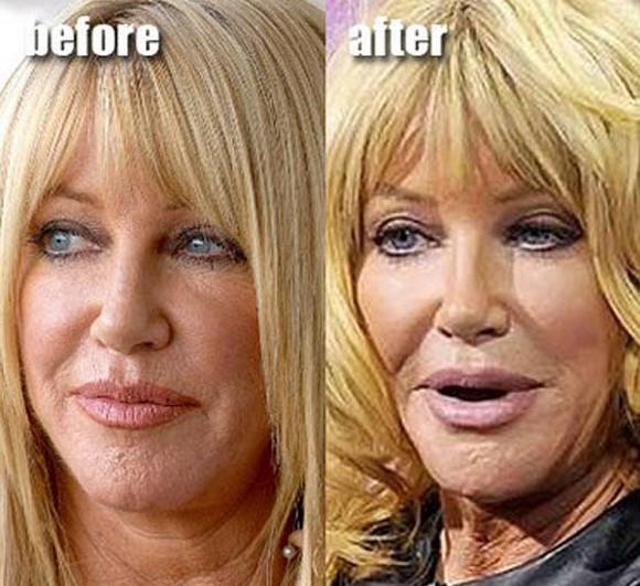 Suzanne Somers plastic surgery gone wrong