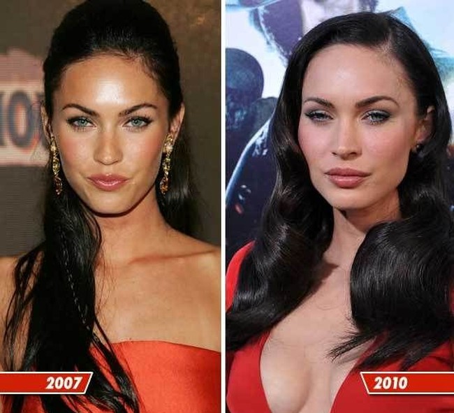 Celebrity before and after plastic surgery