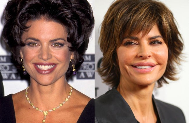 Lisa Rinna Before and After Plastic Surgery