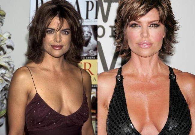 How much Plastic Surgery has Lisa Rinna had over the years?