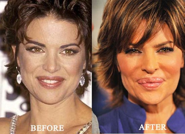 Lisa Rinna before and after lip implants surgery