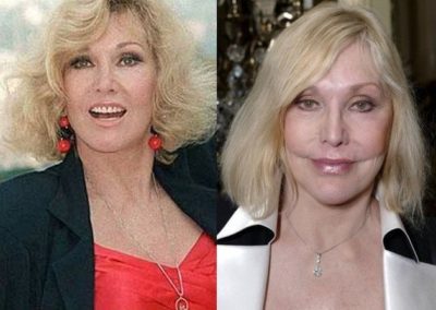 Kim Novak's Bad Transformation After Plastic Surgery