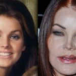 Priscilla Presley Before And After Collagen Lip Injection And Chemical Peel 150x150