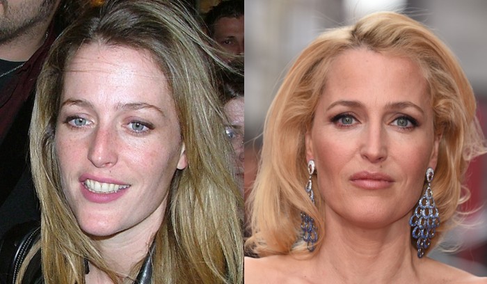 Gillian Anderson Plastic Surgery Rumors and Facts