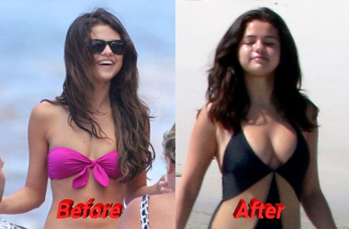 Selena Gomez Nose Job Plastic Surgery, Really?