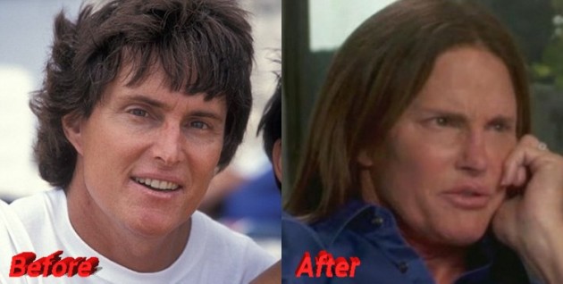 Bruce Jenner Plastic Surgery: From Male Athlete to Female Star