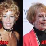 carol burnett plastic surgery before and after