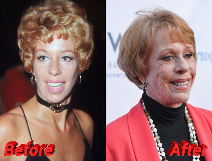 The latest news about Carol Burnett Plastic Surgery Procedures