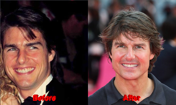 Has Tom Cruise undergone Plastic Surgery?