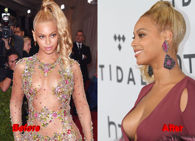 Beyoncé boobs Plastic Surgery