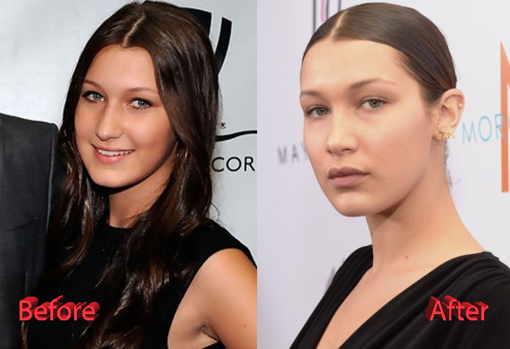 Bella Hadid Nose Job Plastic Surgery: True or Not?