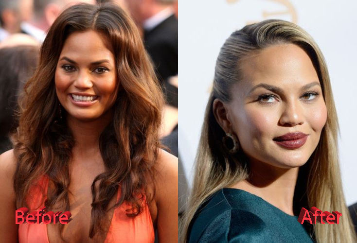 Chrissy Teigen Plastic Surgery Before and After