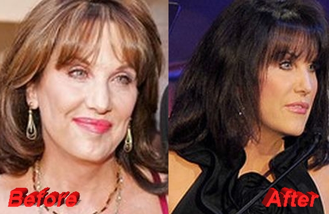 Celebrity Before And After Plastic Surgery