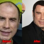John Travolta Plastic Surgery hair before after