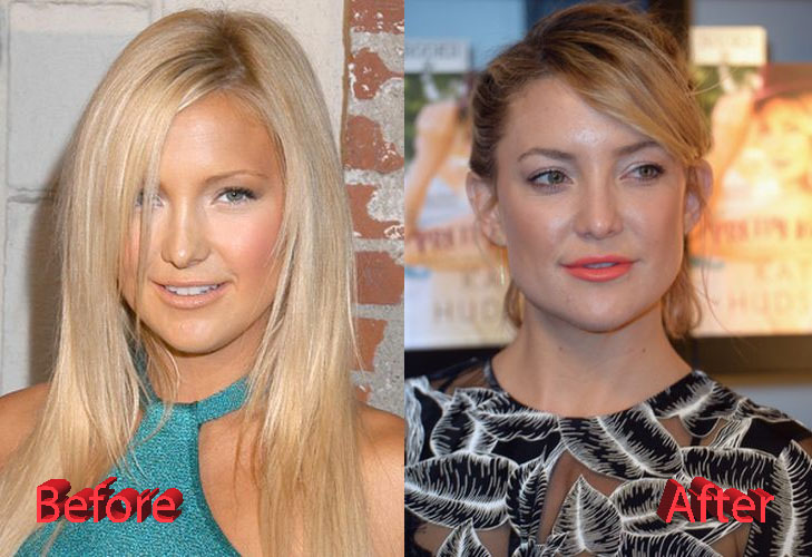 Kate Hudson Plastic Surgery: A Surgery Gone Good