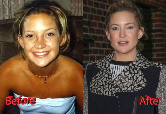 Kate Hudson Plastic Surgery: A Surgery Gone Good