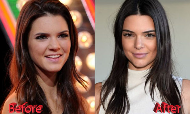 Kendall Jenner’s Plastic Surgery Procedures
