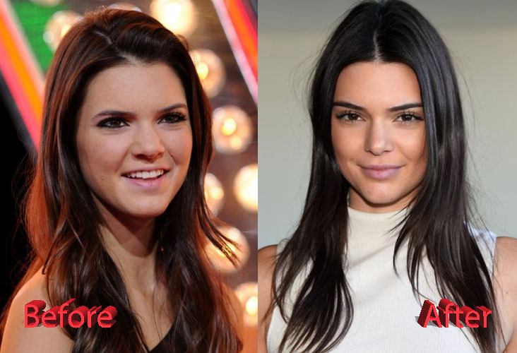 Kendall Jenners Plastic Surgery Procedures